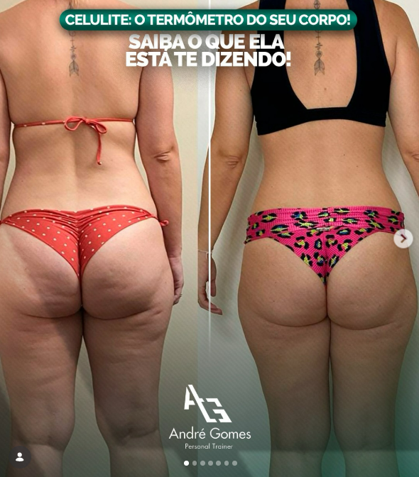 Celulite — antes & depois (posterior)